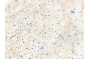 ABIN6256627 and ABIN6267491 at 1/100 staining human astrocytoma by IHC-P.