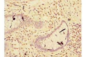 Immunohistochemistry of paraffin-embedded human colon cancer using ABIN7151160 at dilution of 1:100 (RNF181 抗体  (AA 2-153))