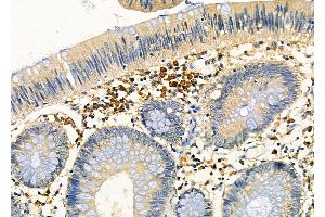ABIN6266309 and ABIN6277454 at 1/100 staining Human colorectal cancer by IHC-P.