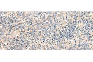 Immunohistochemistry of paraffin-embedded Human cervical cancer tissue using MR1 Polyclonal Antibody at dilution of 1:40(x200) (MR1 抗体)