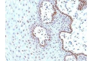 Formalin-fixed, paraffin-embedded human cervical carcinoma stained with c-Myc antibody (9E10. (c-MYC 抗体)