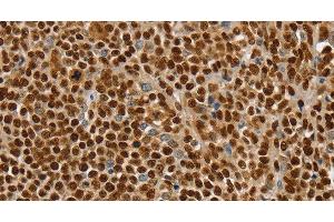 Immunohistochemistry of paraffin-embedded Human ovarian cancer using SSB Polyclonal Antibody at dilution of 1:30 (SSB 抗体)