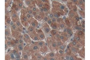 Detection of NPNT in Human Liver cancer Tissue using Polyclonal Antibody to Nephronectin (NPNT) (Nephronectin 抗体  (AA 418-565))