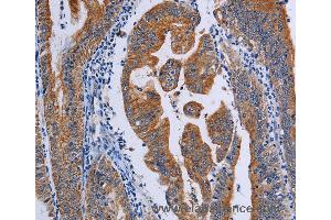 Immunohistochemistry of Human prostate cancer using ACP6 Polyclonal Antibody at dilution of 1:50