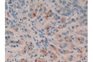DAB staining on IHC-P; Samples: Human Prostate cancer Tissue (SGK2 抗体  (AA 40-311))