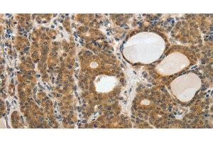 Immunohistochemistry of paraffin-embedded Human thyroid cancer tissue using RARA Polyclonal Antibody at dilution 1:40 (Retinoic Acid Receptor alpha 抗体)