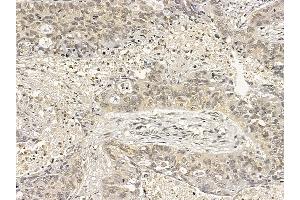 ZAK Mouse Monoclonal Antibody at 1/100 staining human lung cancer and adjacent non-tumor tissue by IHC-P.