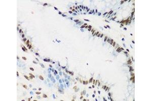Immunohistochemistry of paraffin-embedded Human stomach cancer using KLF4 Polyclonal Antibody at dilution of 1:200 (40x lens). (KLF4 抗体)