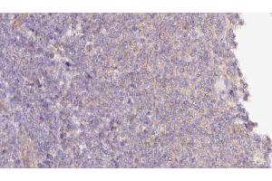ABIN6273058 at 1/100 staining Human lymph cancer tissue by IHC-P. (MTO1 抗体  (N-Term))