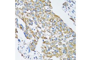 Immunohistochemistry of paraffin-embedded human lung cancer using SLC25A13 antibody. (slc25a13 抗体)