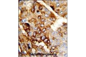 Formalin-fixed and paraffin-embedded human hepatocarcinoma reacted with DERL2 Antibody (C-term), which was peroxidase-conjugated to the secondary antibody, followed by DAB staining. (Der1-Like Domain Family, Member 2 (DERL2) (AA 191-218), (C-Term) 抗体)