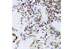 Immunohistochemistry of paraffin-embedded human lung cancer using TAPBP antibody. (TAPBP 抗体)