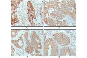Immunohistochemical analysis of paraffin-embedded human breast carcinoma (A), hepatocarcinoma (B), stomach cancer (C) and colon cancer tissue (D), showing cytoplasmic location with DAB staining using CK18 mouse mAb. (Cytokeratin 18 抗体  (AA 391-483))