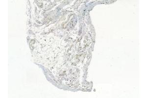 ABIN6255577 and ABIN6267372 at 1/100 staining human testicular cancer by IHC-P.