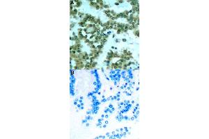 Immunohistochemical staining of human lung cancer tissue by PRKCQ (phospho S676) polyclonal antibody  without blocking peptide (A) or preincubated with blocking peptide (B) under 1:50-1:100 dilution. (PKC theta 抗体  (pSer676))