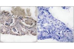 Immunohistochemistry analysis of paraffin-embedded human colon carcinoma tissue, using MARK2 (Ab-596) Antibody. (MARK2 抗体  (AA 562-611))