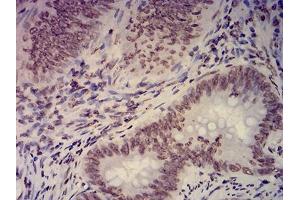Immunohistochemical analysis of paraffin-embedded rectum cancer tissues using EHMT2 mouse mAb with DAB staining. (EHMT2 抗体  (AA 317-471))