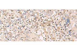 Immunohistochemistry of paraffin-embedded Human cervical cancer tissue using EPSTI1 Polyclonal Antibody at dilution of 1:25(x200) (EPSTI1 抗体)