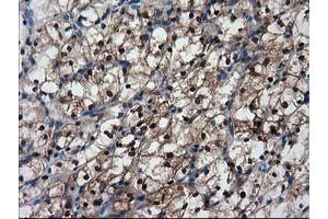 Immunohistochemical staining of paraffin-embedded Carcinoma of Human kidney tissue using anti-NNMT mouse monoclonal antibody. (NNMT 抗体)