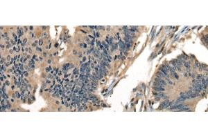 Immunohistochemistry of paraffin-embedded Human colorectal cancer tissue using DNAJC2 Polyclonal Antibody at dilution of 1:40(x200) (DNAJC2 抗体)