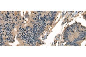Immunohistochemistry of paraffin-embedded Human colorectal cancer tissue using DNAJC2 Polyclonal Antibody at dilution of 1:40(x200)