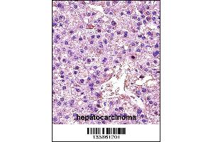 LDHA Antibody immunohistochemistry analysis in formalin fixed and paraffin embedded human hepatocarcinoma followed by peroxidase conjugation of the secondary antibody and DAB staining. (Lactate Dehydrogenase A 抗体  (C-Term))