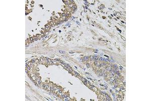 Immunohistochemistry of paraffin-embedded human prostate using GRN antibody (ABIN6292502) at dilution of 1:100 (40x lens). (Granulin 抗体)