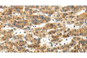 Immunohistochemistry of paraffin-embedded Human ovarian cancer tissue using PAPPA Polyclonal Antibody at dilution of 1:50 (PAPPA 抗体)