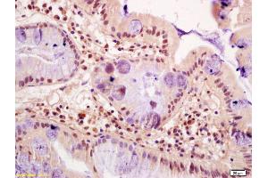 Formalin-fixed and paraffin embedded human gastric cancer labeled with Anti-FZR1/CDC20C Polyclonal Antibody, Unconjugated (ABIN1714172) at 1:200 followed by conjugation to the secondary antibody and DAB staining (FZR1 抗体  (AA 141-240))