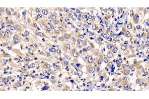 Detection of CTSK in Human Liver cancer Tissue using Polyclonal Antibody to Cathepsin K (CTSK) (Cathepsin K 抗体  (AA 71-319))