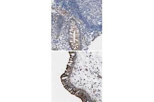 Immunohistochemical staining of human nasopharynx with TWISTNB polyclonal antibody  shows strong cytoplasmic and membranous positivity in respiratory epithelial cells at 1:200-1:500 dilution. (TWIST Neighbor 抗体)