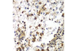 Immunohistochemistry of paraffin-embedded human kidney cancer using SND1 antibody at dilution of 1:100 (40x lens). (SND1 抗体)
