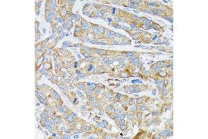 Immunohistochemistry of paraffin-embedded human esophageal cancer using Cytokeratin 1 (KRT1) (KRT1) Rabbit mAb (ABIN7268085) at dilution of 1:100 (40x lens). (Cytokeratin 1 抗体)