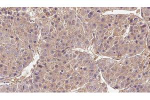 ABIN6279265 at 1/100 staining Human liver cancer tissue by IHC-P. (CATSPER4 抗体  (Internal Region))