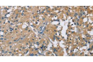 Immunohistochemistry of paraffin-embedded Human thyroid cancer using CAB39L Polyclonal Antibody at dilution of 1:40 (CAB39L 抗体)