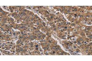 Immunohistochemistry of paraffin-embedded Human liver cancer tissue using JAG2 Polyclonal Antibody at dilution 1:30 (JAG2 抗体)
