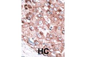 Formalin-fixed and paraffin-embedded human hepatocellular carcinoma tissue reacted with the BAK1 polyclonal antibody  , which was peroxidase-conjugated to the secondary antibody, followed by AEC staining. (BAK1 抗体  (N-Term))