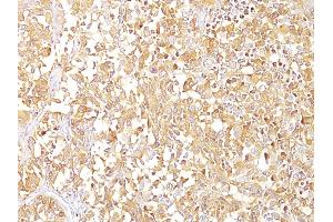 Formalin-fixed, paraffin-embedded human Melanoma stained with gp100 / Melanosome Monoclonal Antibody (SPM142). (Melanoma gp100 抗体)