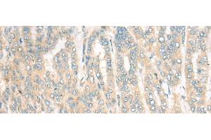 Immunohistochemistry of paraffin-embedded Human liver cancer tissue using CDKAL1 Polyclonal Antibody at dilution of 1:60(x200)