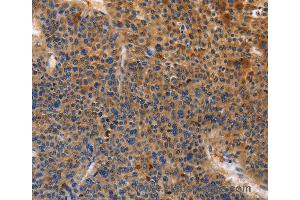 Immunohistochemistry of Human cervical cancer using MUSK Polyclonal Antibody at dilution of 1:30 (MUSK 抗体)