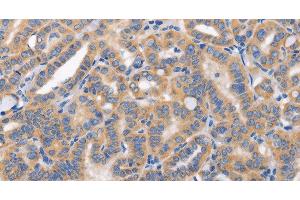 Immunohistochemistry of paraffin-embedded Human thyroid cancer tissue using CARD17 Polyclonal Antibody at dilution 1:50 (CARD17 抗体)