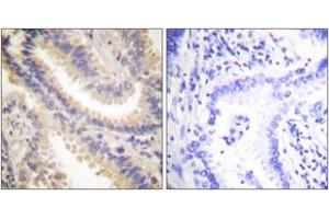 Immunohistochemistry analysis of paraffin-embedded human lung carcinoma tissue, using TIMP4 Antibody. (TIMP4 抗体  (AA 175-224))