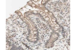 ABIN6267631 at 1/200 staining human colon cancer tissue sections by IHC-P. (PRKAA1 抗体  (pSer486))