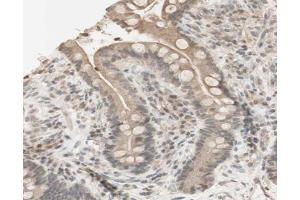 ABIN6267631 at 1/200 staining human colon cancer tissue sections by IHC-P.