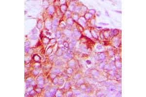 Immunohistochemical analysis of GPR116 staining in human breast cancer formalin fixed paraffin embedded tissue section.