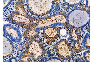 ABIN6257488 and ABIN6275420 at 1/100 staining Human ovarian cancer by IHC-P. (S100A5 抗体  (Internal Region))