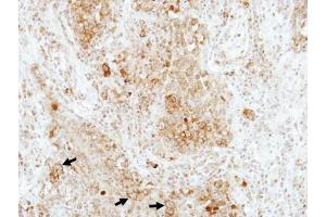 IHC-P Image Immunohistochemical analysis of paraffin-embedded human lung adenocarcinoma, using RAP1B, antibody at 1:100 dilution. (RAP1B 抗体)