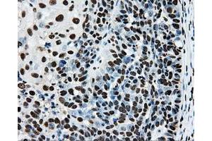 Immunohistochemical staining of paraffin-embedded Adenocarcinoma of breast tissue using anti-RPA2 mouse monoclonal antibody. (RPA2 抗体)