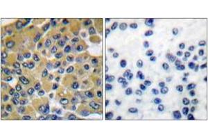 Immunohistochemistry analysis of paraffin-embedded human breast carcinoma tissue, using SHP-2 (Ab-542) Antibody. (PTPN11 抗体  (AA 508-557))
