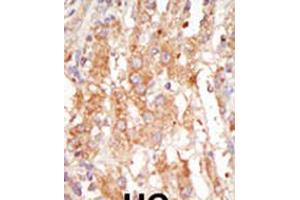 Formalin-fixed and paraffin-embedded human cancer tissue reacted with the primary antibody, which was peroxidase-conjugated to the secondary antibody, followed by DAB staining. (MAP3K6 抗体  (C-Term))